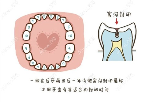 儿童牙齿窝沟封闭是几颗牙一起做