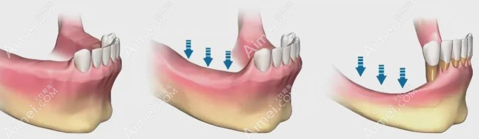 牙槽骨萎缩过程