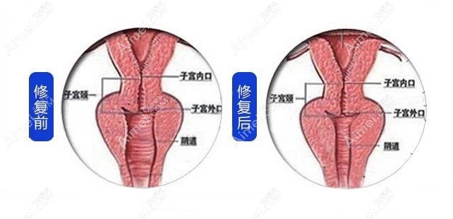 手术缩阴前和缩阴手术后的对比