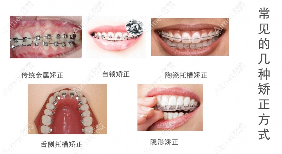 常用的牙齿矫正器类型