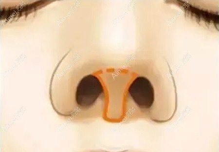 鼻小柱缩短手术部位