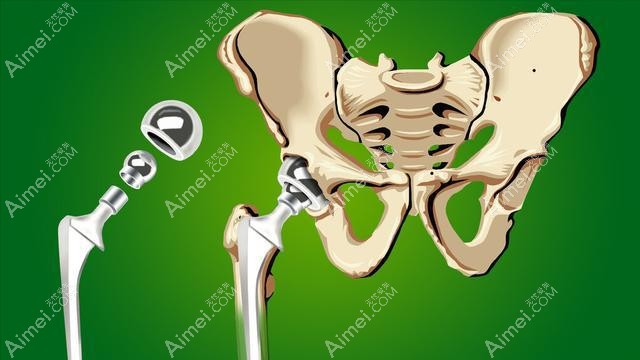 人工双侧股骨头置换手术是多少钱?做二次置换能不能报销