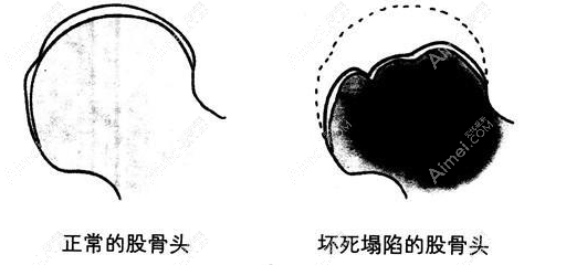 股骨头坏死做置换手术