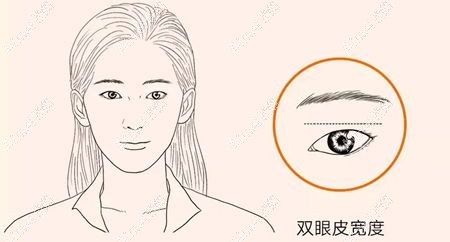 双眼皮线条弧度生硬属于双眼皮8种失败表现m.51aimei.com.jpg