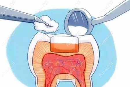 为什么补牙医生不建议用树脂的,聊聊树脂补牙的好处和坏处