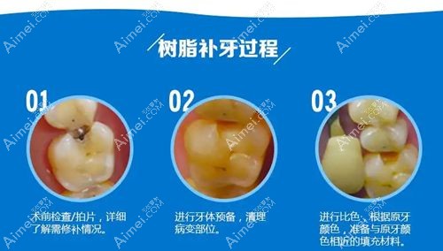 牙医用树脂补牙的过程分享m.aimei.com.jpg