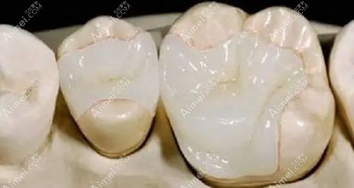 树脂补牙的外观和真实牙齿颜色差不多www.aimei.com.jpg