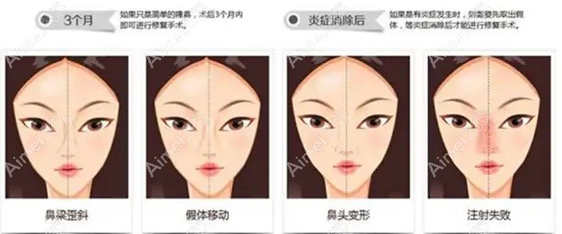 北京隆鼻修复类型