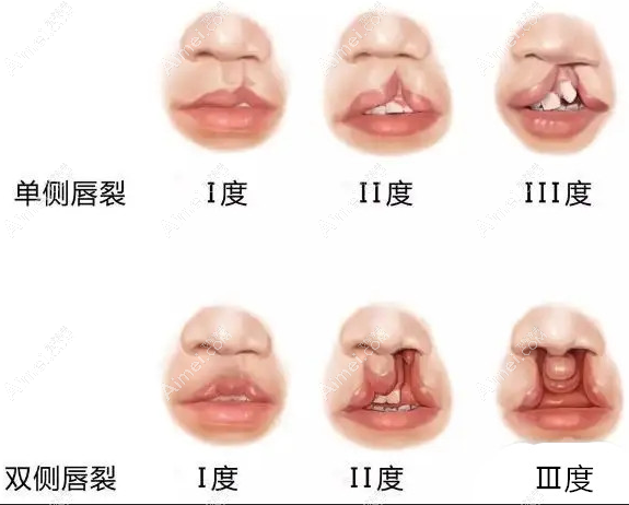 唇裂的程度不同修复次数和疗效不同