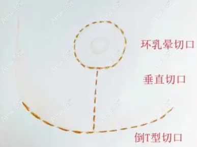 西安画美易成刚医生缩胸切口