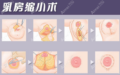 北京美莱高超医生缩胸过程aimei.com