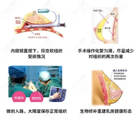 廣州中家醫(yī)家庭醫(yī)生胸部奧美定取出修復(fù)