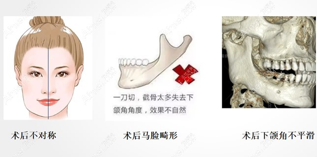 下颌角被切掉可以补吗?3d打印人工骨修复是有效的补骨方法