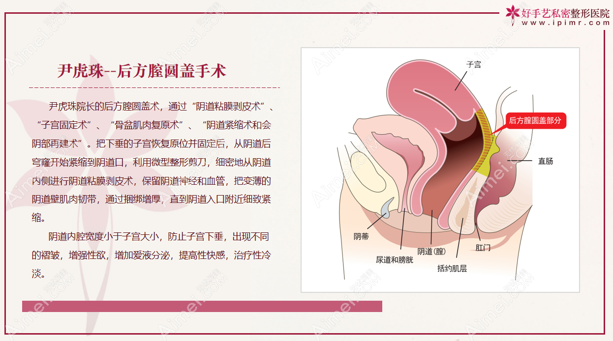 韩国好手艺医院特色手术是后方膣圆盖阴道紧缩术