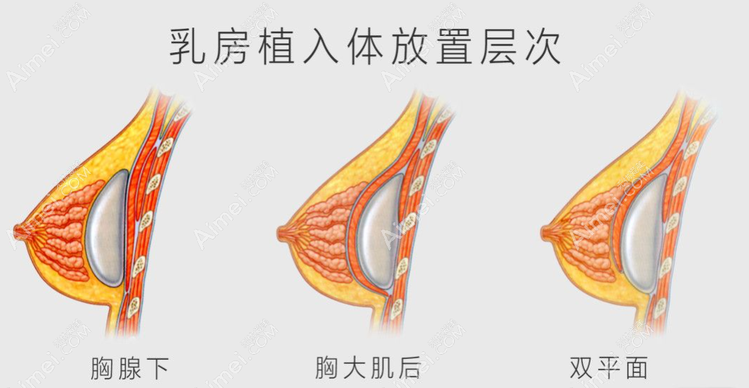 假体隆胸大力压会移位但不会被打出来