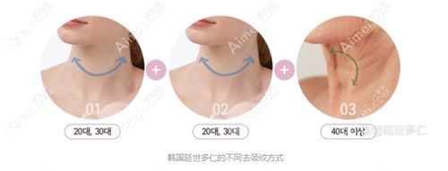 韩国延世多仁整形外科去颈纹手术详解.jpg