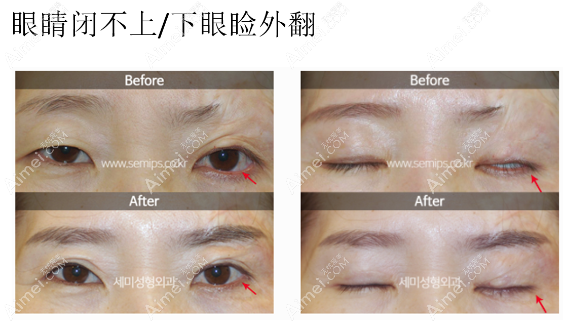 韩国世美整形外科医院朴相炫医生下眼角外翻修复前后对比图