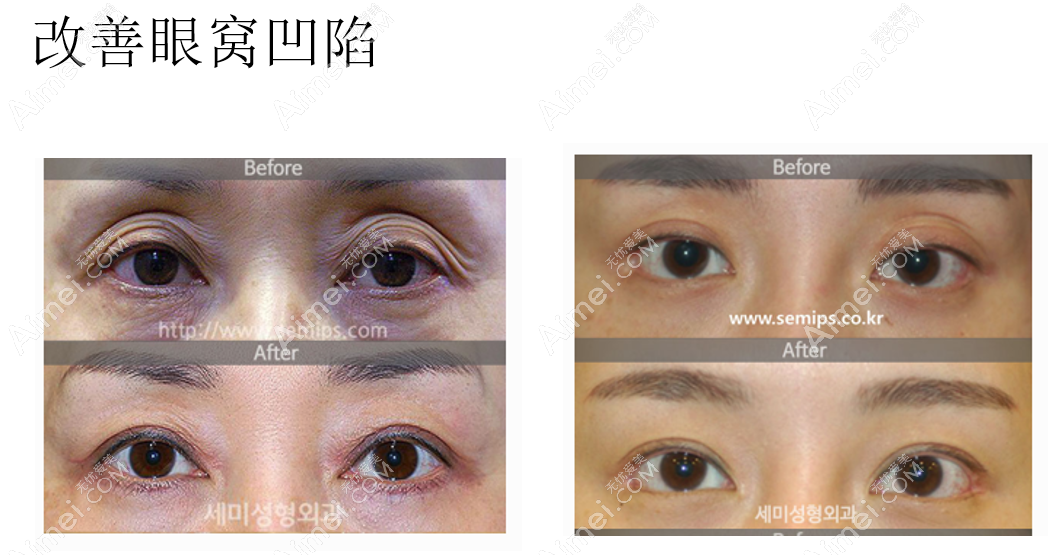 韩国世美整形外科医院朴相炫医生眼窝凹陷修复前后对比照片
