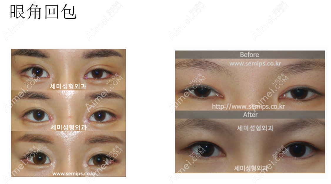 韩国世美整形医院朴相炫医生眼角回包修复前后对比照片