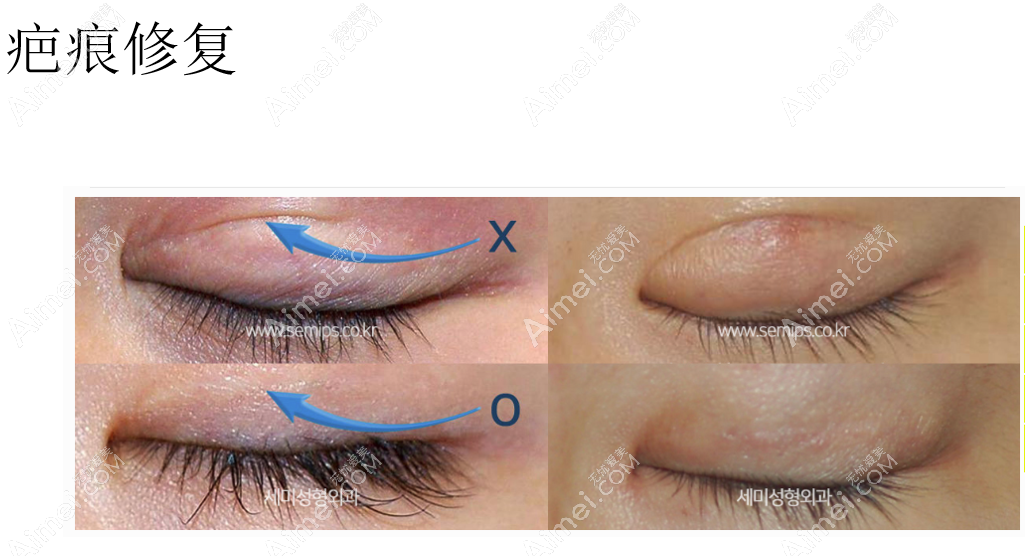 韩国世美整形外科医院双眼皮疤痕眼修复前后对比照片