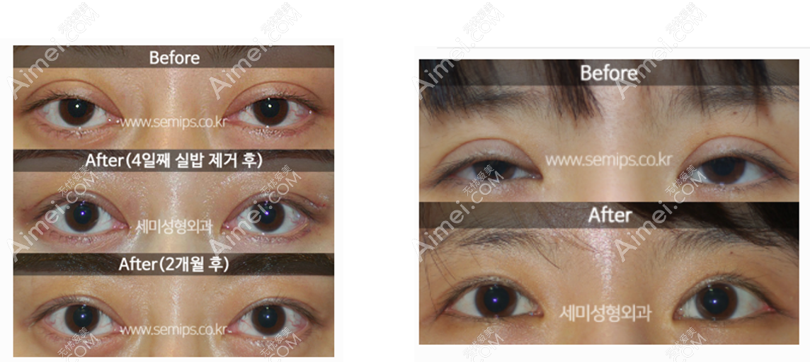 韩国世美医院朴相炫医生双眼皮肉条修复前后对比图片