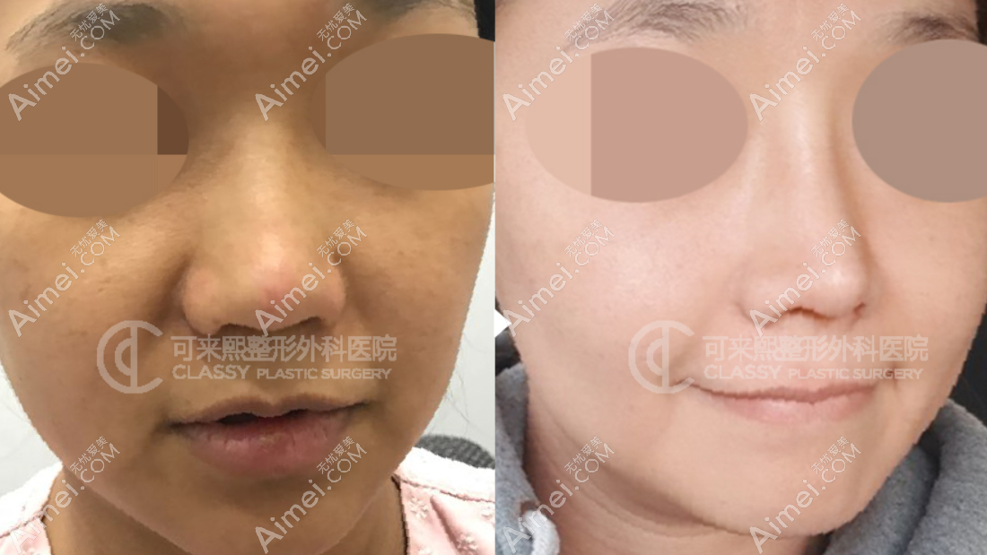 韩国可来熙医院朴圣勋医生鼻修复一个月对比图片