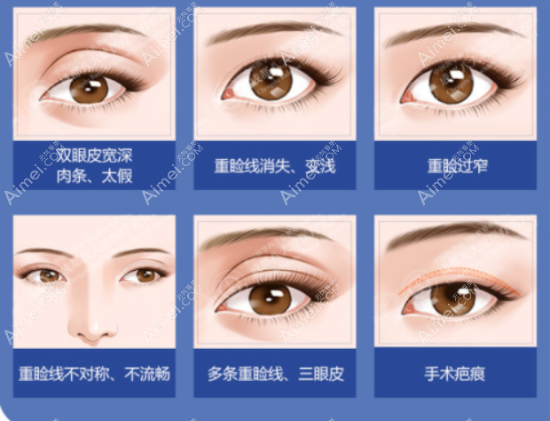 北京双眼皮修复价格便宜的医生是谁