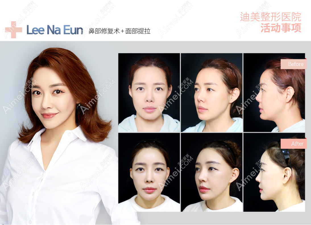 韩国迪美整形医院鼻修复+面部提升对比图片