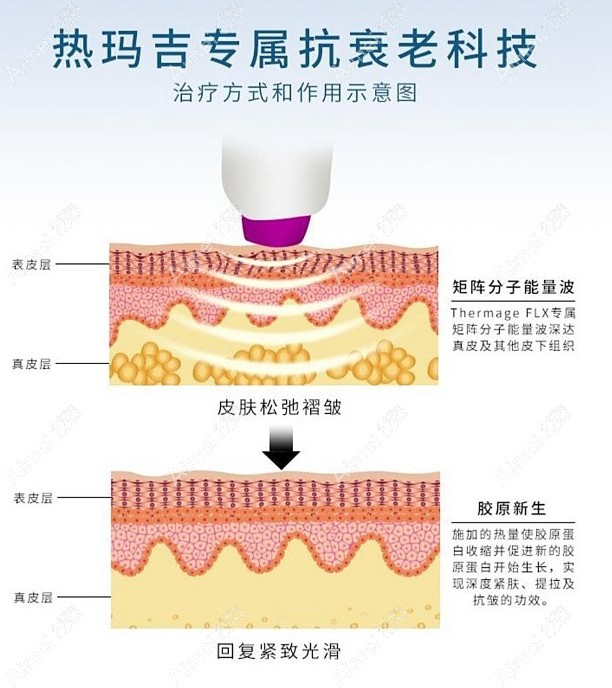 热玛吉治疗原理及层次