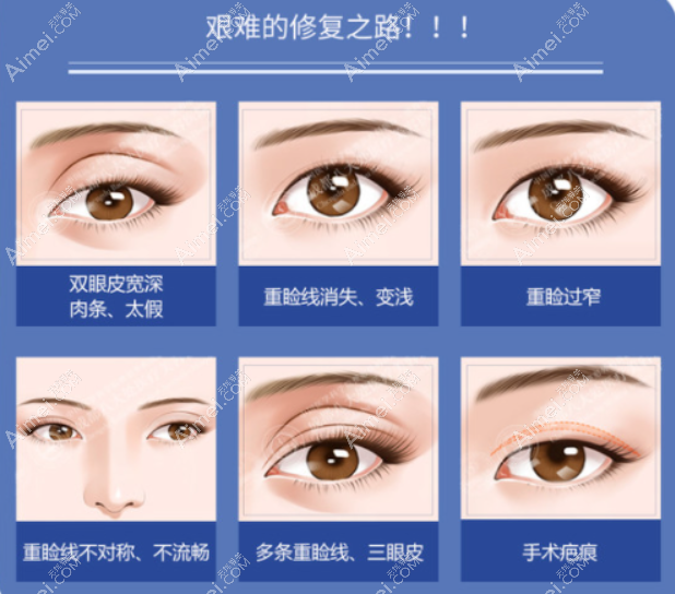 平顶山艺美医院全切双眼皮修复价格 平顶山艺美医院全切双眼皮修复价格
