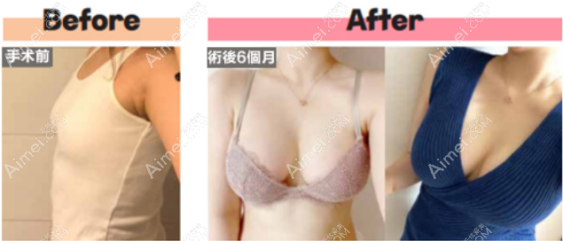 韩国欧佩拉整形医院假体隆胸对比图