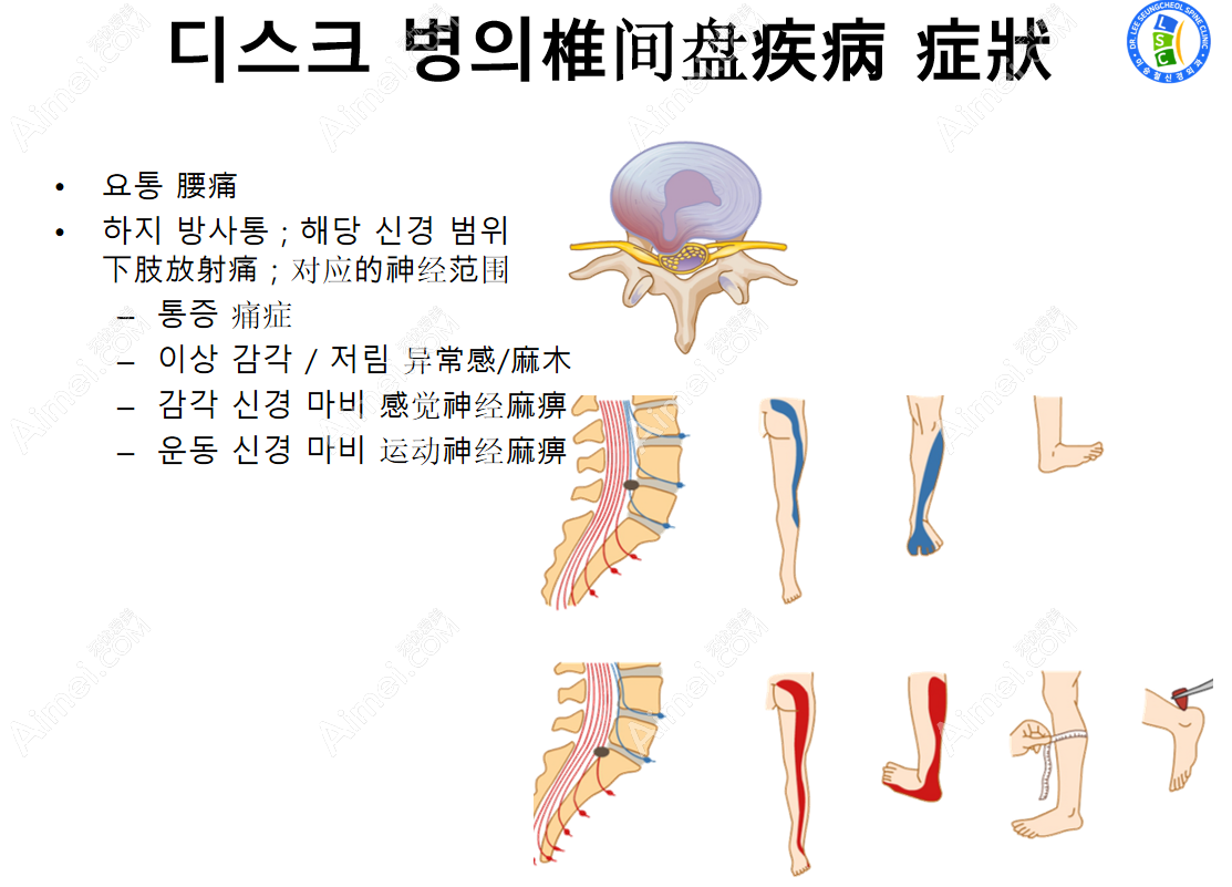 韩国李承哲神经外科颈椎病治疗价格表