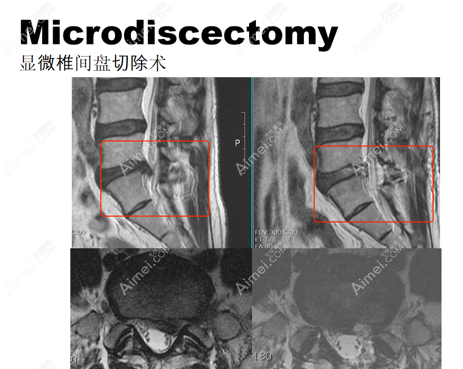 韩国李承哲神经外科腰椎间盘切除前后对比图片