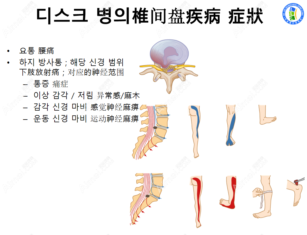 韩国李承哲神经外科医院脊椎病治疗适合人群