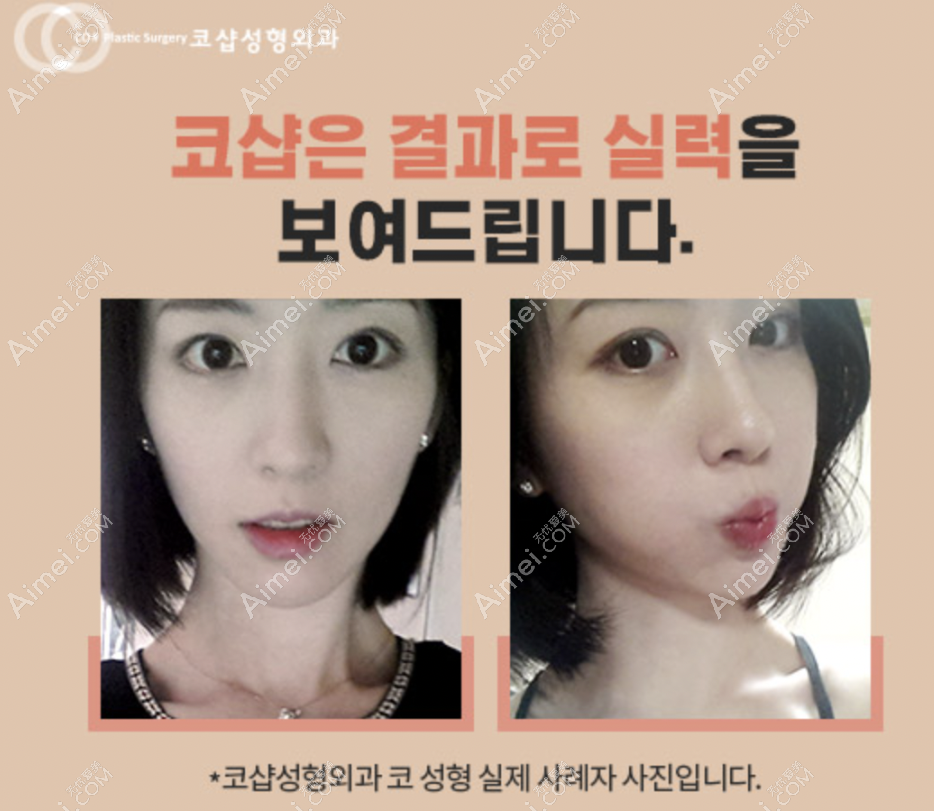 韩国碧夏医院鼻子修复前后对比图片和真人实例