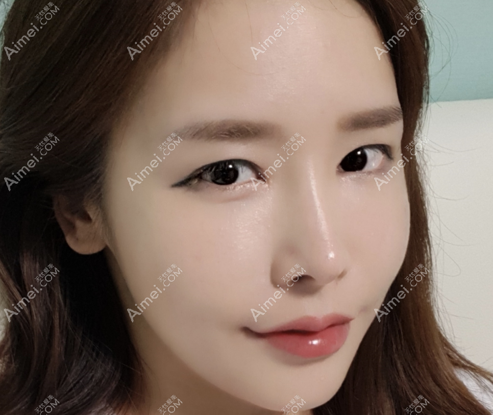 韩国碧夏医院李珉仕院长鼻综合隆鼻图片