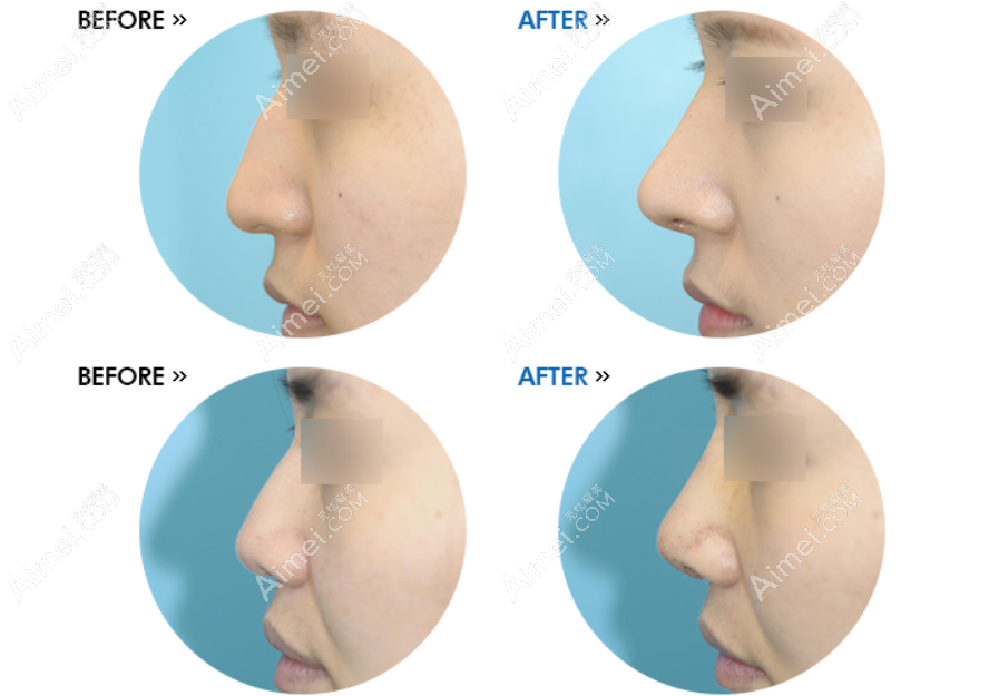 韩国碧夏整形医院李珉仕院长驼峰鼻矫正修复对比照片