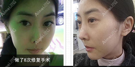 韓國4月31日金載勛多次鼻修復(fù)對(duì)比圖