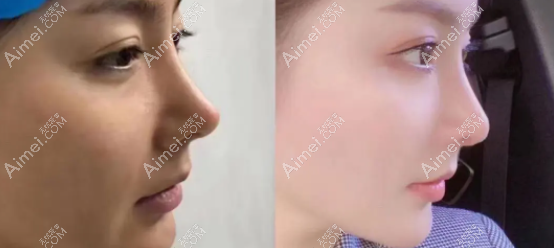 韓國赫拉李丙玟肋軟骨鼻修復(fù)前后對(duì)比