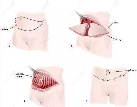 腹壁成型手术过程分享m.aimei.com.jpg