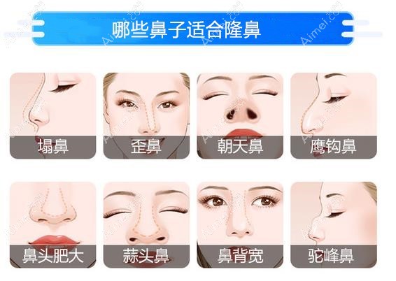 杭州隆鼻排名前三医院中，杭州清沐和清锴专门做鼻子整形