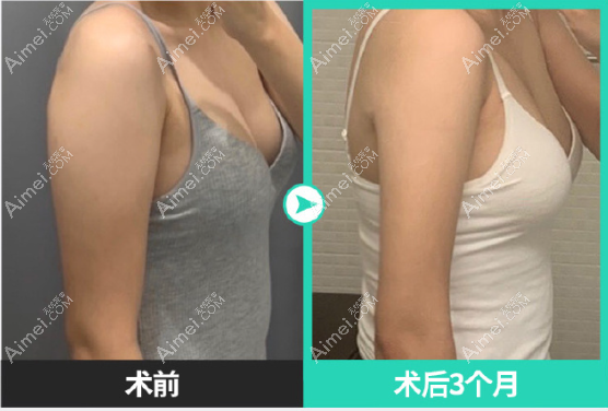 韩国宝士丽整形医院手臂吸脂3个月前后对比照片