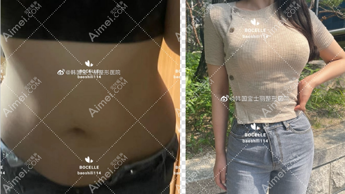 韩国宝士丽医院腰腹环吸真人实例图片 韩国宝士丽医院腰腹环吸真人实例图片