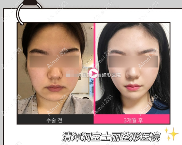 韩国宝士丽医院面部吸脂+埋线提升对比图片