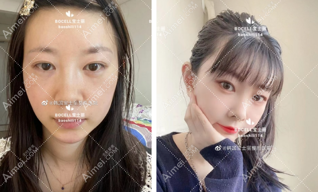 韩国宝士丽医院全脸脂肪填充3个月对比照片 韩国宝士丽医院全脸脂肪填充3个月对比照片