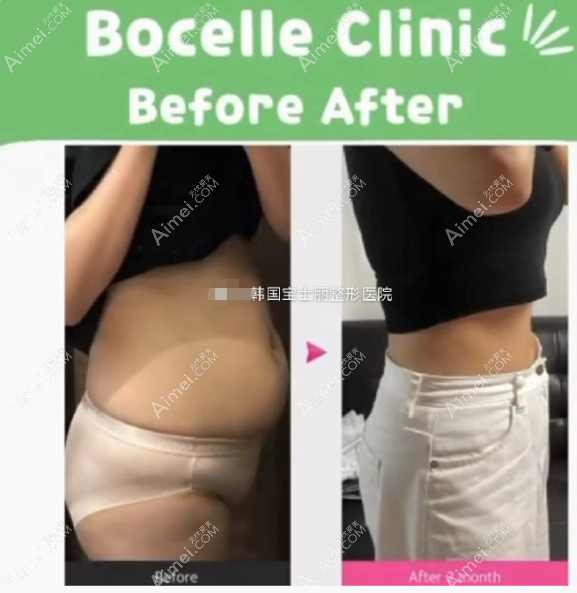 韩国宝士丽医院腰腹吸脂2个月对比图片