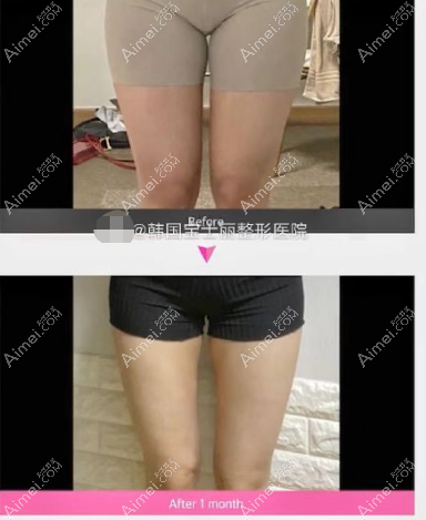 韩国宝士丽整形医院大腿吸脂前后对比照片
