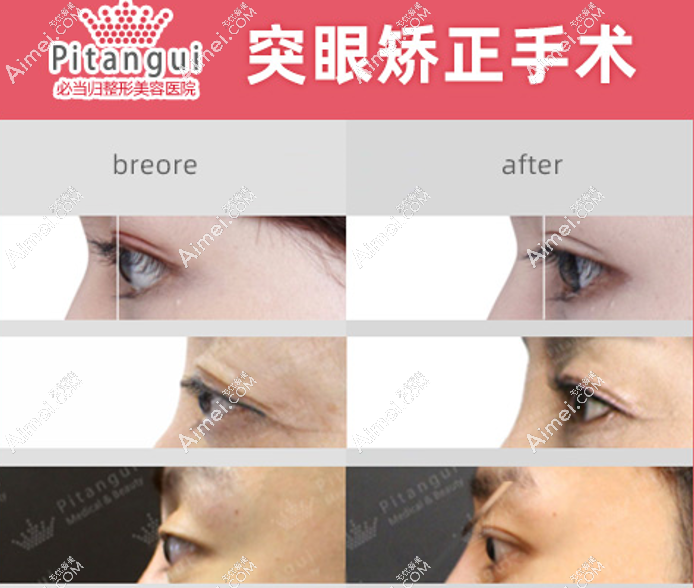 韩国突眼手术矫正对比图aimei.com