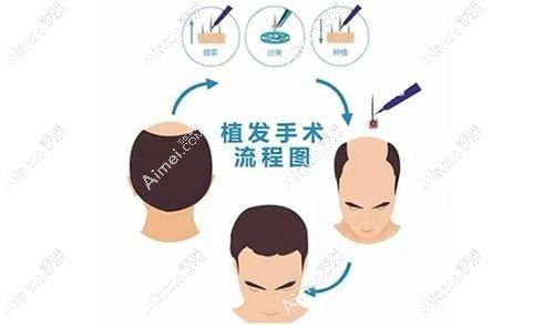 韩国毛发移植手术流程