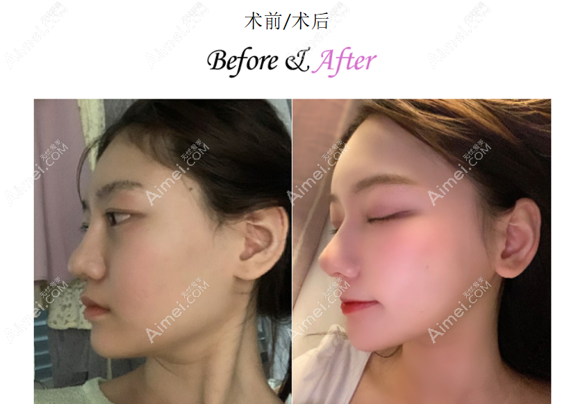 韩国gng医院眼修复前后对比图片及真人实例